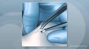Common Procedure: No-Scalpel Vasectomy - Capital Urology